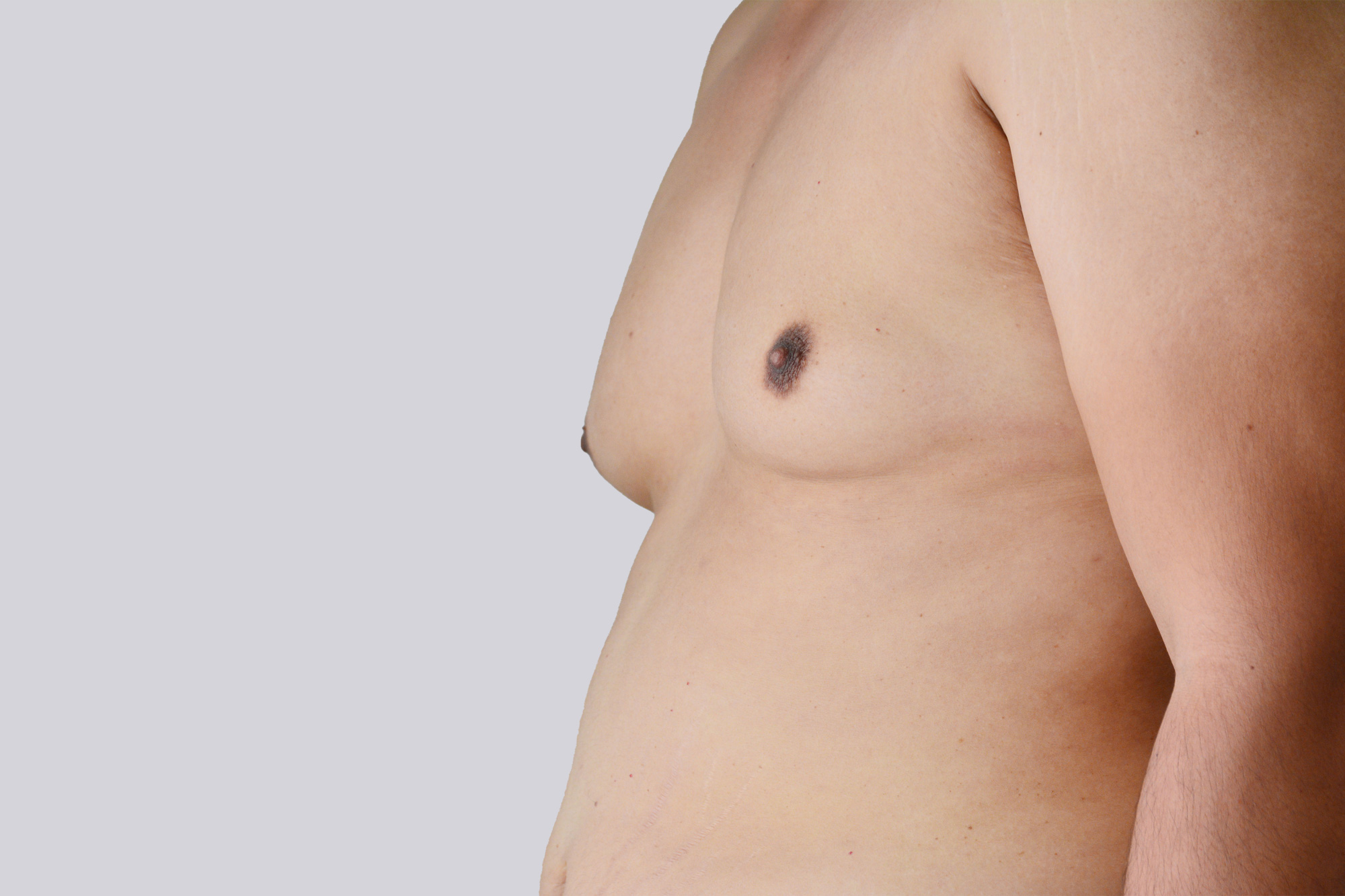 Bauchdeckenstraffung Frankfurt