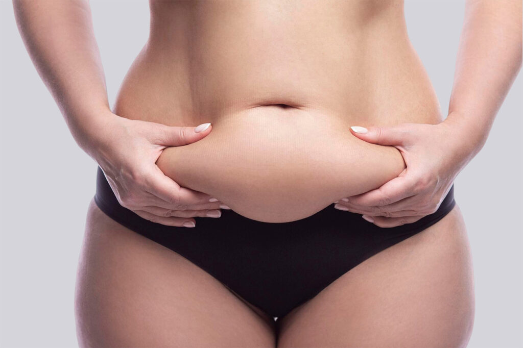 Bauchdeckenstraffung vs. Minibauchdeckenstraffung